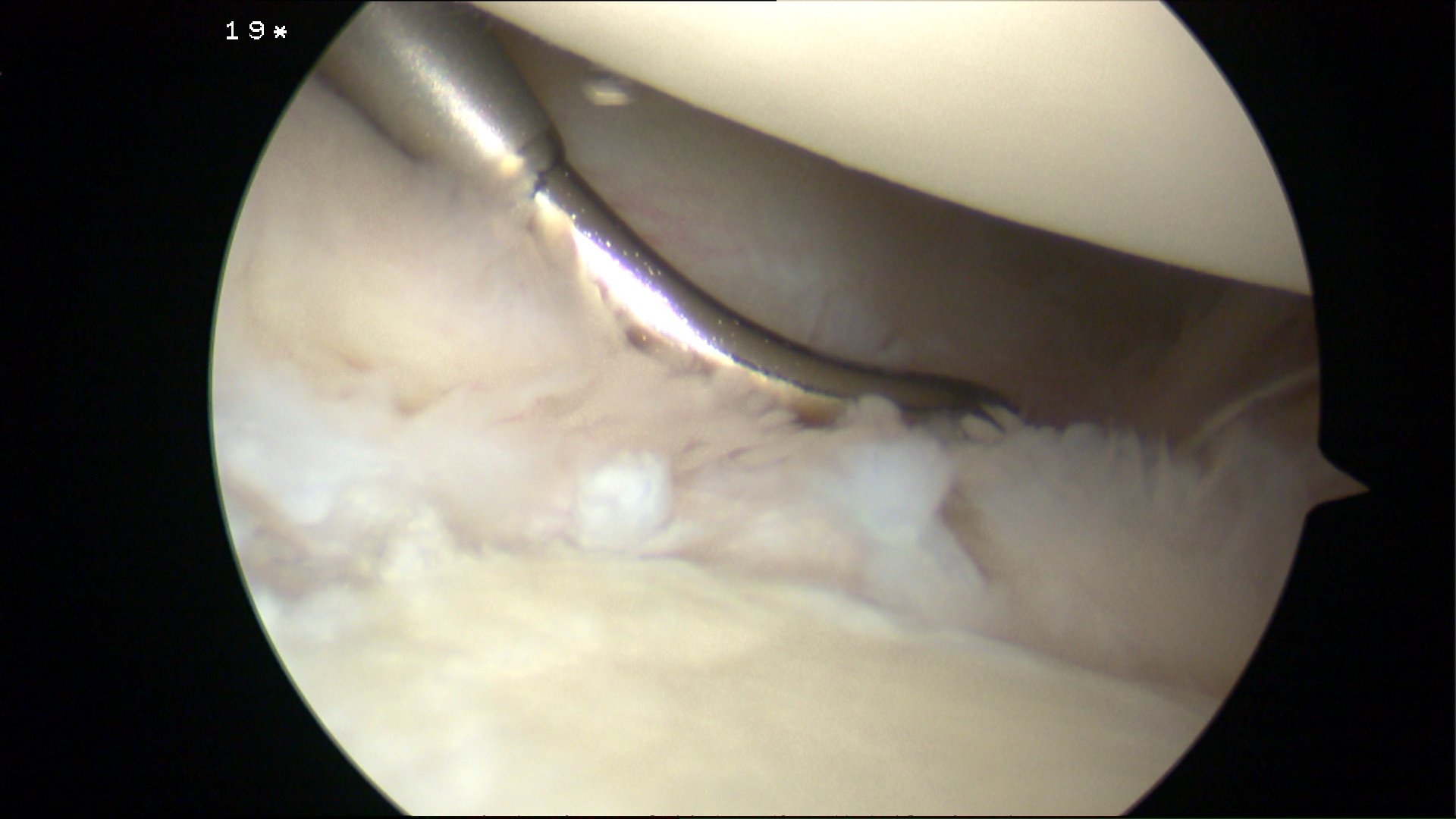 Shoulder Instability inferior Suture passage